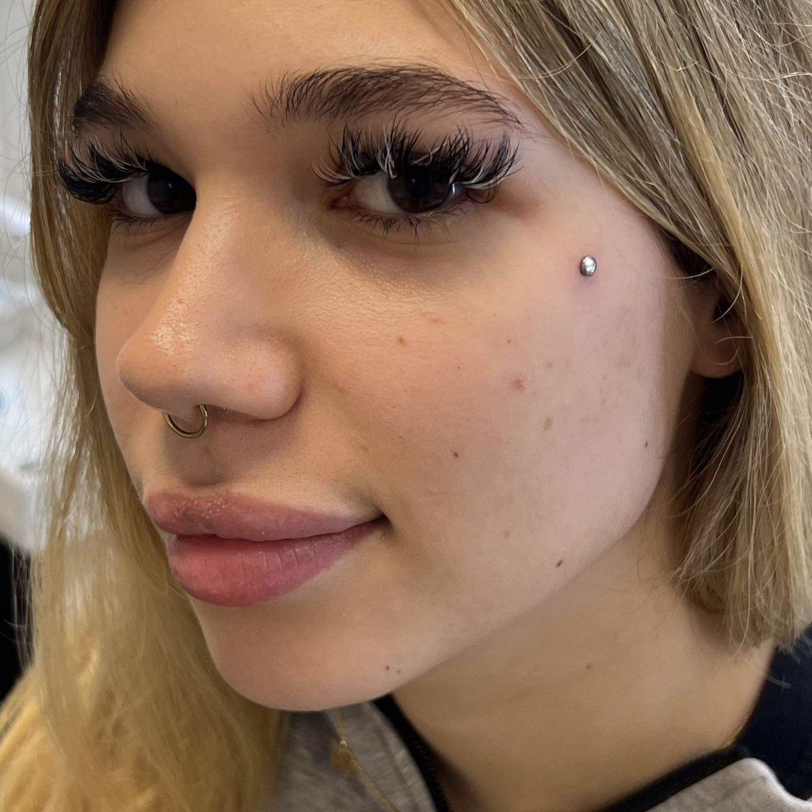 MICRODERMAL